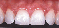 ząb odbudowany