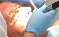 Leczenie parodontozy
